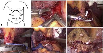A novel Laennec's capsule tunnel approach for pure laparoscopic left hemihepatectomy: a propensity score matching study